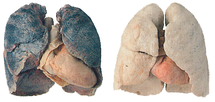 comparaison du poumon d'un fumeur avant et après l'arrêt de la cigarette