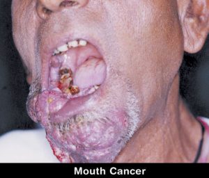cancer de la bouche