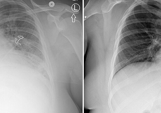 L’U of U Health sur une piste dans l’affaire US du vapotage au THC